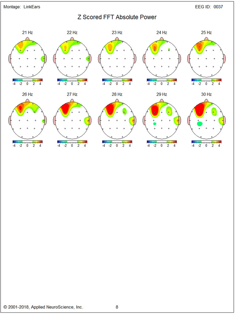 Figure 3 - Baseline eyes-closed z-score FFT absolute power single-Hz bins 21-30 Hz